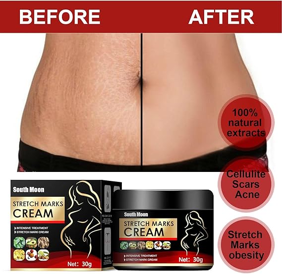 Stretch Marks Removal Cream,Scar Removal Cream - Stretch Mark Cream Remover for Pregnancy Skin Care, Stretch Marks Scar Remove