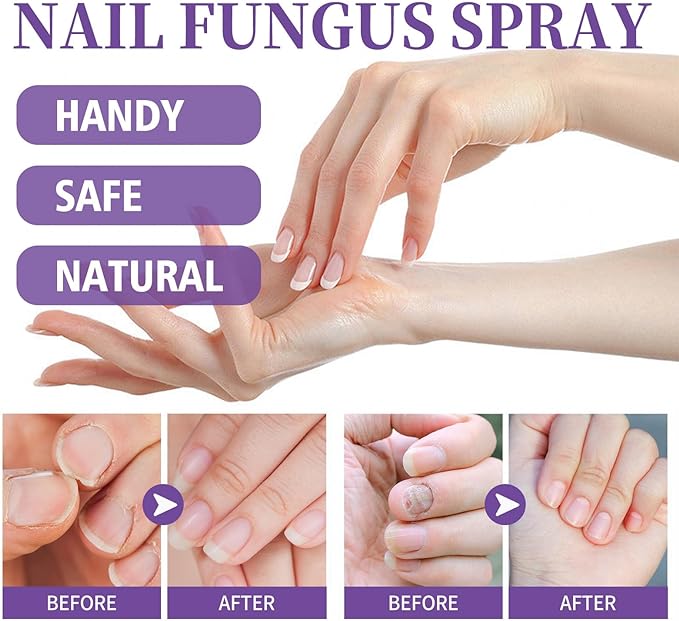 Emi's Nail Fungus Spray